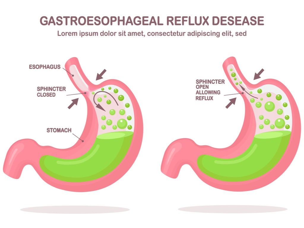 Reflusso gastroesofageo - Sintomi, cause, cura e consigli utili