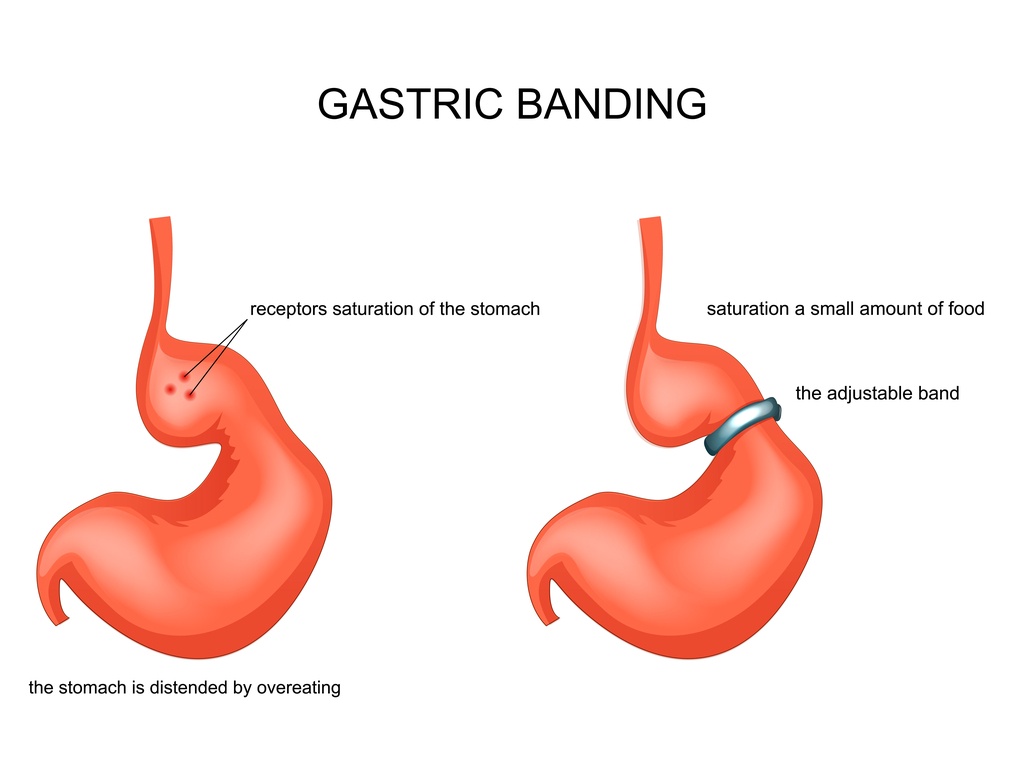 cos'è il bendaggio gastrico