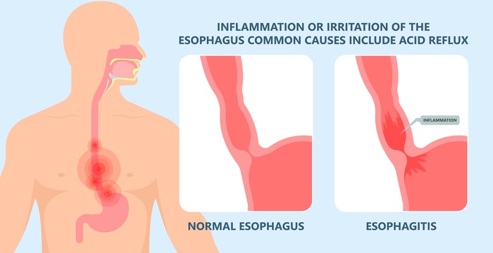 esofagite
