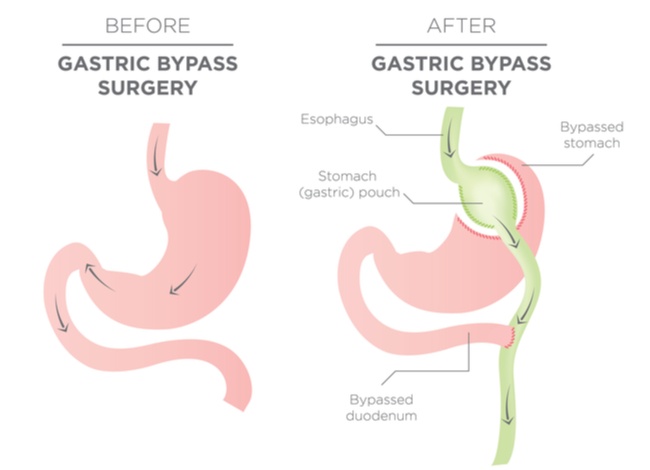 Che-cos'è-il-bypass-gastrico-luigi-angrisani