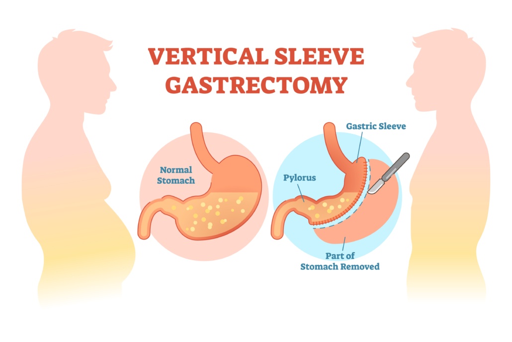 Sleeve-Gastrectomy-Slim-Gastrectomy-Gastrectomia-Verticale