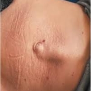 I muscoli retti dell’addome sono due strutture muscolari parallele che si estendono dallo sterno al pube. Tra di loro è presente una struttura fibrosa chiamata linea alba. Nella diastasi, questa linea si allarga e si indebolisce, determinando un aumento della distanza tra i due muscoli. Questo comporta una perdita della normale funzione di contenimento e sostegno della parete addominale.